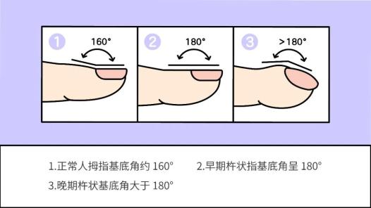 杵状指既可能是后天原因造成,也可能是遗传性病变.