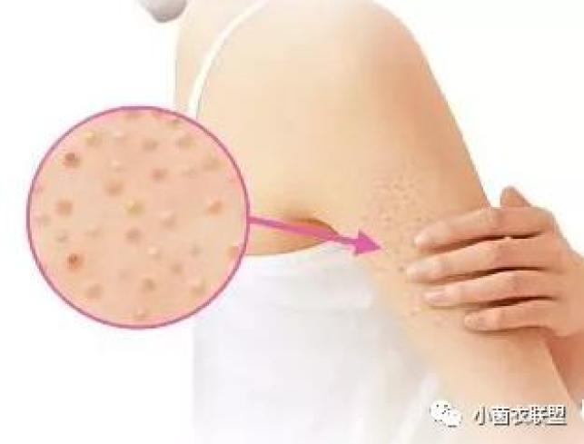 这是一种皮肤病,学名是:毛周角化症,又称毛发角化病或毛发苔藓等,是一
