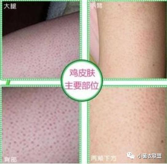 毛周角化症外观很像"鸡皮疙瘩",但一般的"鸡皮疙瘩"乃因气候或情绪等