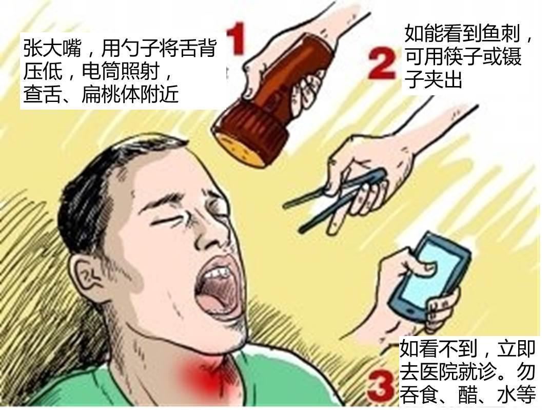福州女子舌下深藏鱼刺一个月后才发现结果