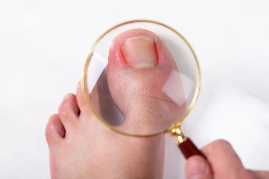 初期,甲沟炎的红肿和疼痛症状都比较轻微,这是脚趾头在提醒你:快治治