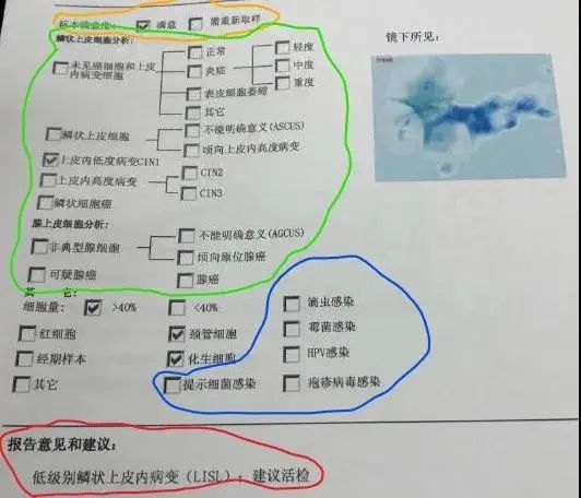 薄层液基制片细胞学检测,是目前国际上最先进的宫颈癌细胞学检查技术