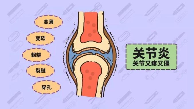 强直性脊柱炎痛风性关节炎或反应性性关节炎等