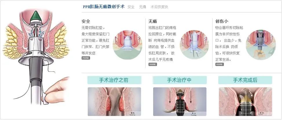 医疗援藏|定日县人民医院成功开展首例吻合器痔上粘膜