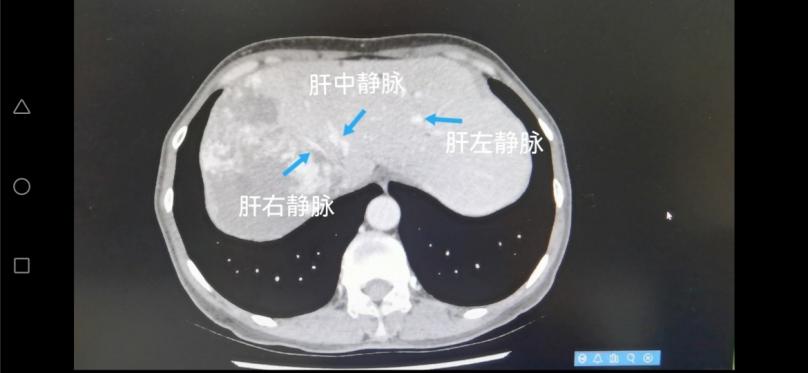 1周"入院,入院诊断:肝占位性病变,腹部增强ct提示肝右叶巨大血管瘤