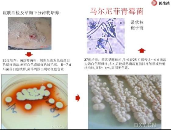 左右滑动查看答案问题来了,什么是马尔尼菲青霉菌呢?