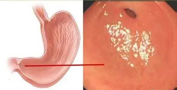 胃窦部,圆口就是幽门口,通向十二指肠