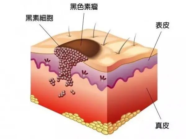 黑痣危险什么情况