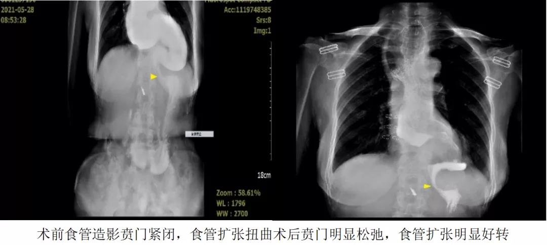 消化内科完成两例贲门失弛缓症困难poem术