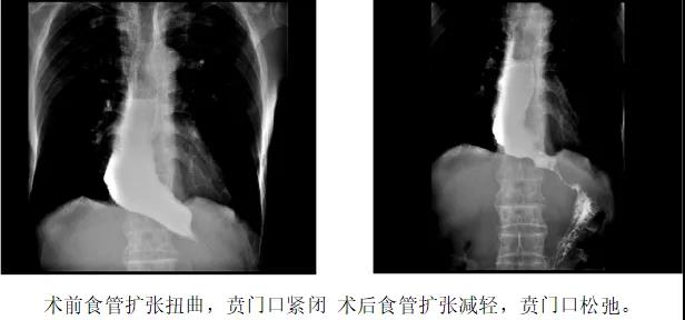 消化内科完成两例贲门失弛缓症困难poem术