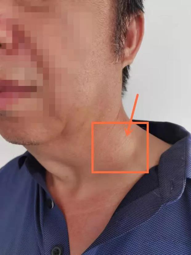 脖子长6厘米"疙瘩"原发病灶难寻,齐鲁医院青岛院区耳鼻咽喉头颈外科