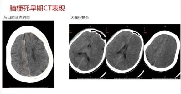 急性脑梗死首选影像学检查是