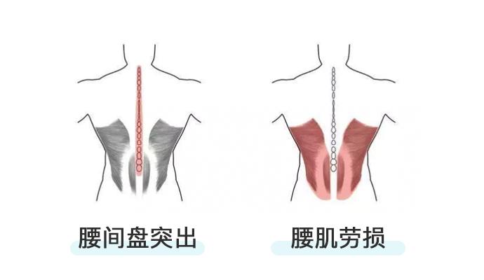 腰疼是腰肌劳损还是腰间盘突出