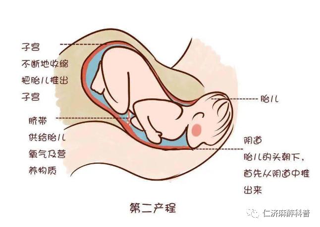 使劲朝阴道或肛门方向推挤胎儿