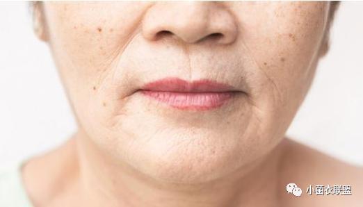 口周皮肤老化也是导致口周皱纹的原因.