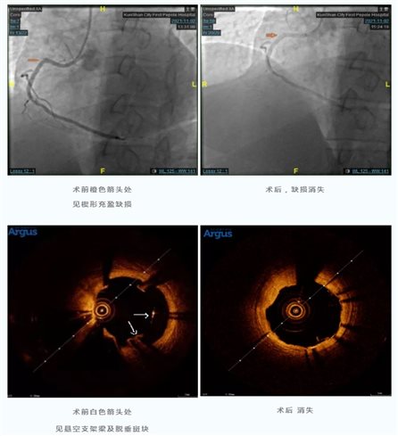 【临床实录】新一代oct,冠脉介入医生的"黄金眼"