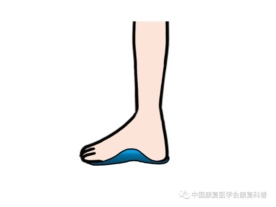03脚踩滚轴患者取坐位或站立位,将滚轴放在足弓的位置,使脚可以踩在