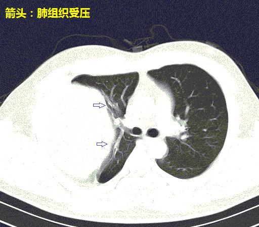 肺窗 澎拜新闻