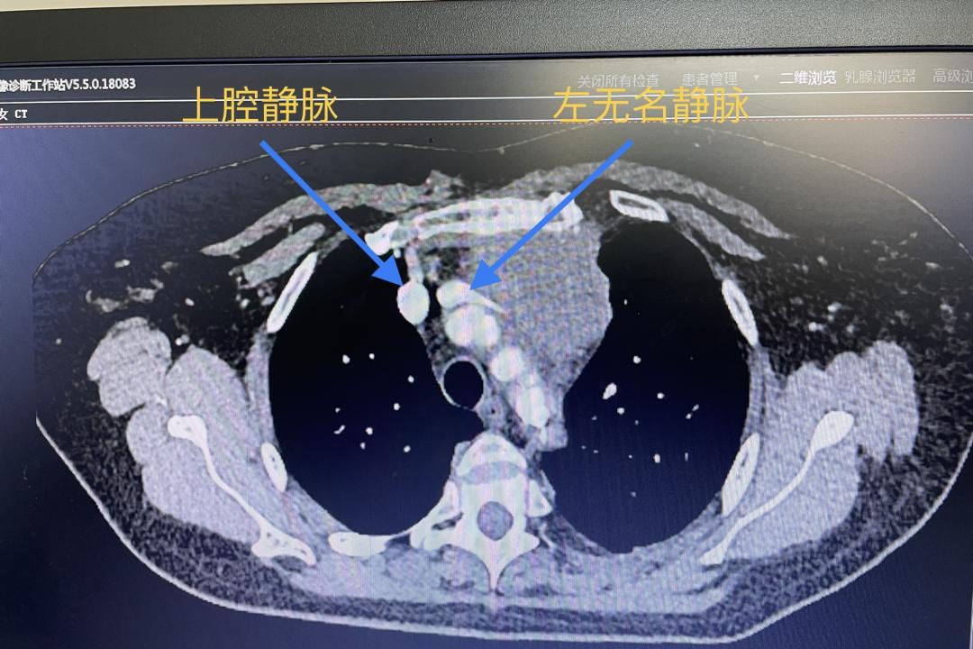例高风险,高难度巨大复杂胸腺癌扩大切除术 自体心包管左无名静脉成
