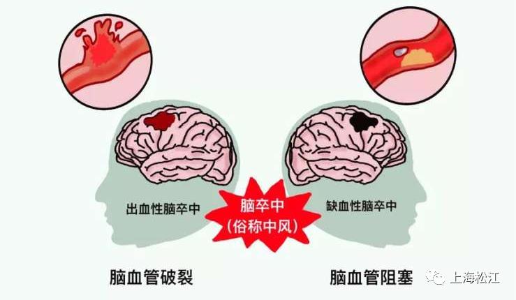 出血性卒中 澎拜新闻