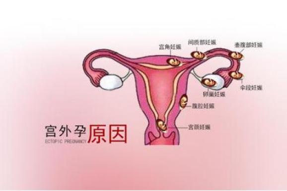 输卵管宫外孕:半路抛锚的受精卵