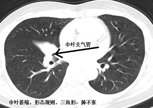 肺不张ct读片太难看完这篇文章轻松入门