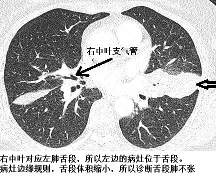 肺不张ct读片太难看完这篇文章轻松入门