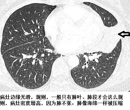 肺不张ct读片太难看完这篇文章轻松入门