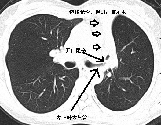 肺不张ct读片太难看完这篇文章轻松入门