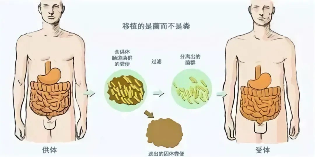 臭名远扬的医学技术粪菌移植