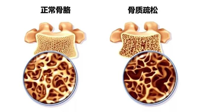 盐与基质呈正常比例,以单位体积内骨组织量减少为特点的代谢性骨病变