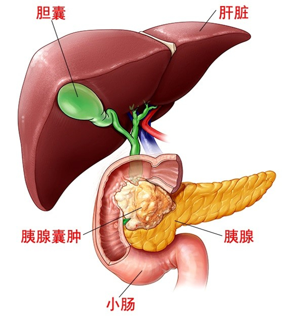 三十岁女性遇上胰头巨大肿瘤机器人联合胰胆镜精准手术切瘤保胰创纪录