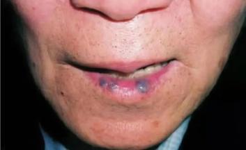 嘴唇上的黑点挤破后竟然出了一手血