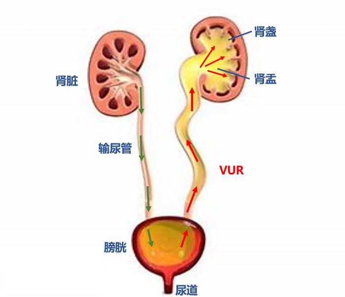 什么是膀胱输尿管反流(vur)?