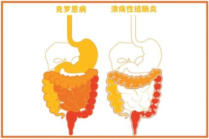 慢性炎症为特征的疾病总称,它主要有2种类型:溃疡性结肠炎和克罗恩病