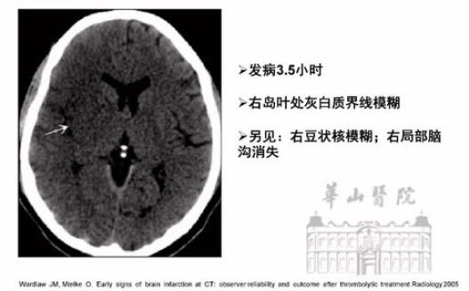 脑梗死急诊大咖教你看透ct片子