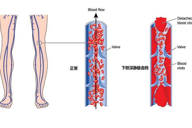 血管里的小恶魔深静脉血栓出现这些情况要小心