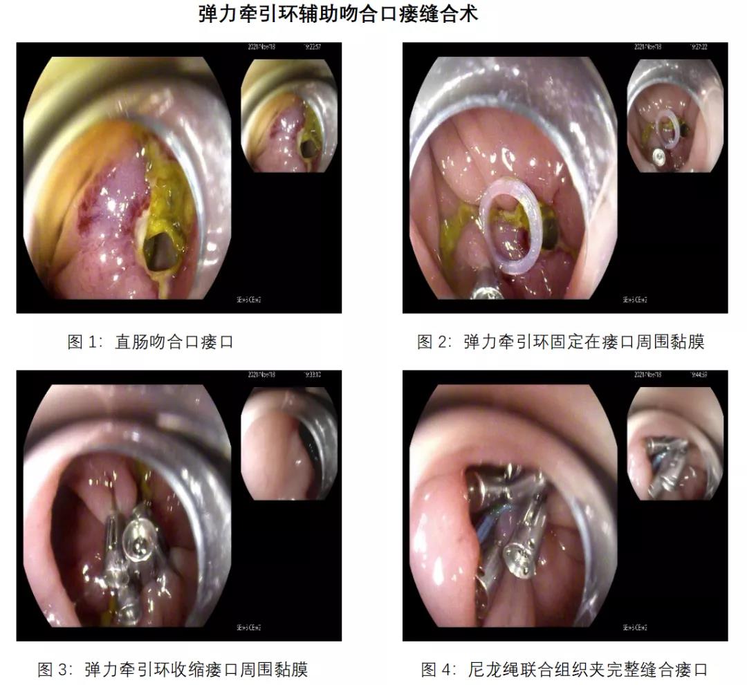 齐鲁医院青岛院区消化内科完成国际首例弹力牵引环辅助吻合口瘘内镜下
