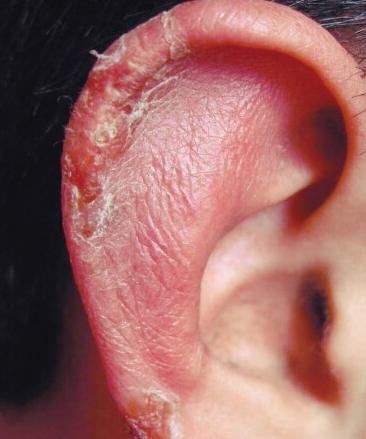 由于耳朵皮肤很薄,对于温度变换表现的比较敏感,这就是为什么耳朵总是