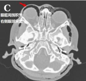 患者为什么突然就纵膈气肿,广泛皮下气肿了呢?下一步该怎么办?