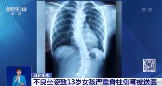 曙光便民青少年脊柱侧弯莫忽视我院东西两院分别开设青少年脊柱侧弯