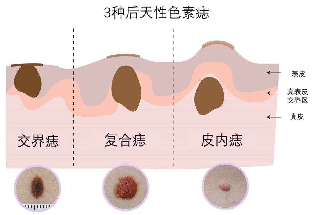 表现为中央凸起的丘疹,周围有褐色斑片环绕