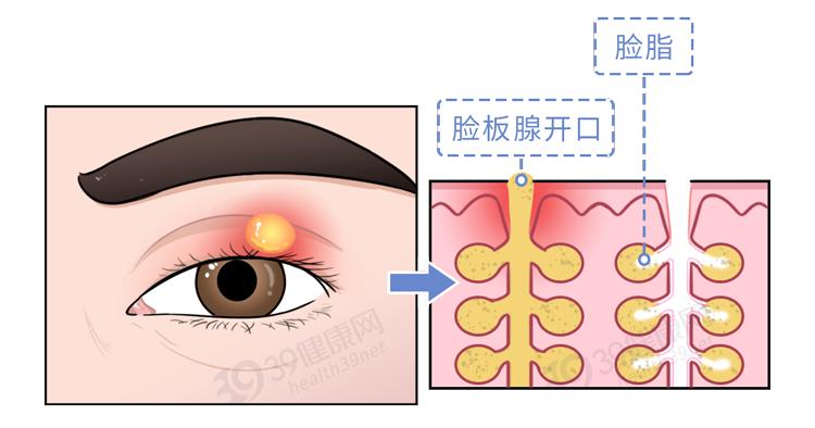 澎湃号>39健康网>称为内麦粒肿形成较大的脓肿第一种是因为睑板腺发炎