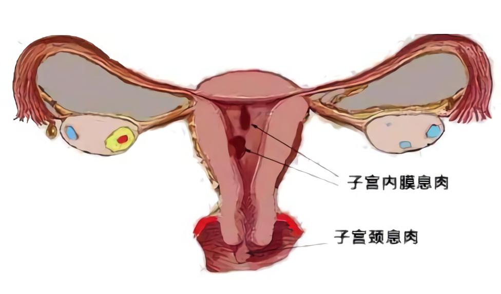 内膜有息肉严重吗