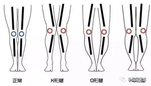 李明讲中医治疗膝关节骨性关节炎调摄新思路下肢力线理论