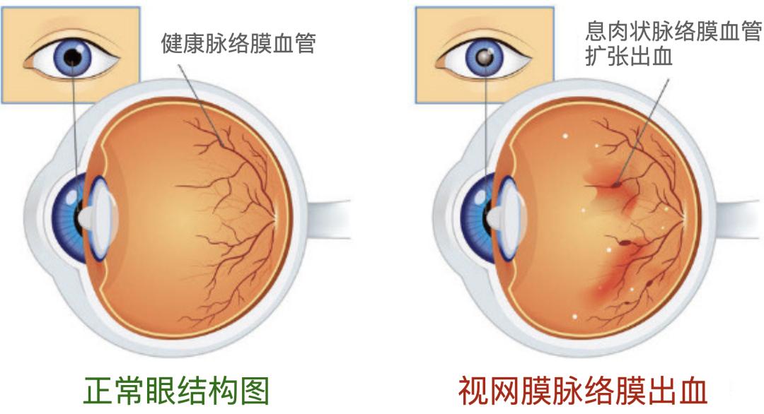 息肉状脉络膜血管病变(polypoidal choroidal vasculopathy,pcv)是一