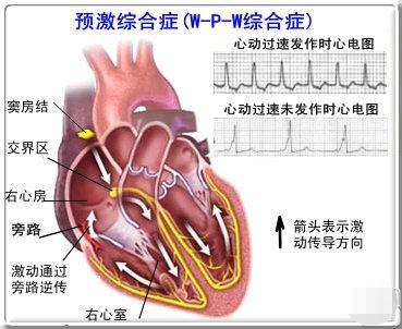 预激综合征心脏不走寻常路