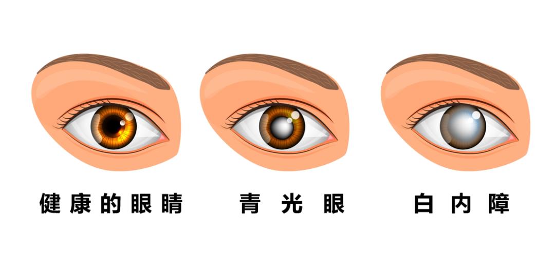 同济健康青光眼比白内障更凶险的致盲性眼病