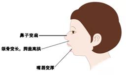 腭盖高拱,上下牙弓不匹配,上前牙前突,牙列拥挤,长脸,被称为"腺样体