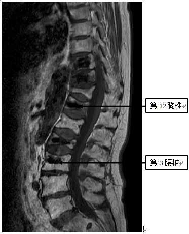 门诊核磁共振检查示,胸9-12椎体,腰1-3椎体连续7个椎体压缩性骨折